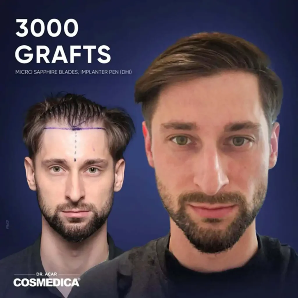 5 Key Insights into Turkey Hair Transplant Cost Turkey Hair Transplant